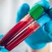 Indian startup develops AI-based blood test to detect 32 cancers early