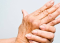 Rheumatoid Arthritis