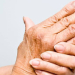 Rheumatoid Arthritis