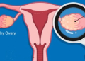 Ovarian Cancer