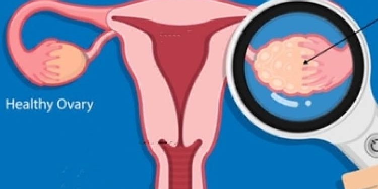 Ovarian Cancer