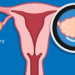 Ovarian Cancer