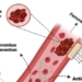 Blood Clotting