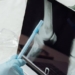 Bone Cancer