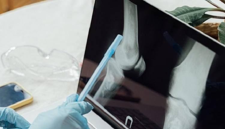 Indian Researchers Develop Diagnostic Device To Detect Early-Stage Bone Cancer