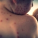 measles