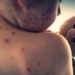 Measles Alert
