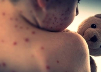 Measles Outbreak