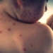 Measles Outbreak