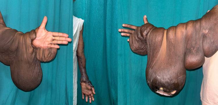 7-Kg Rare Arm Tumour